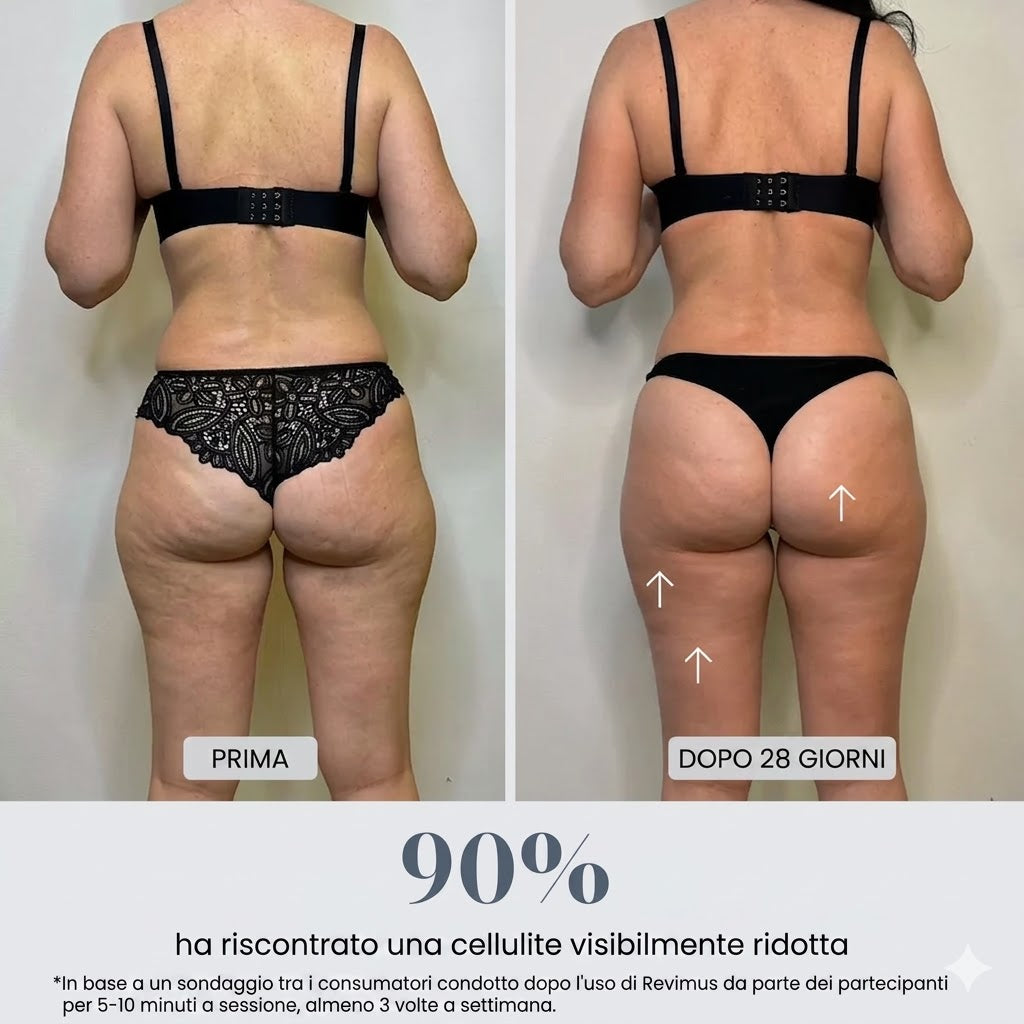 Massaggiatore a Coppettazione Anticellulite