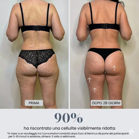 Massaggiatore a Coppettazione Anticellulite